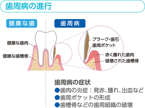 歯周病の進行・歯周病の症状の図解イラスト